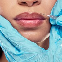 A photo of a woman receiving a lip flip at Dr. Laurel Bailey Laser and Aesthetics in Mechanicsburg, PA