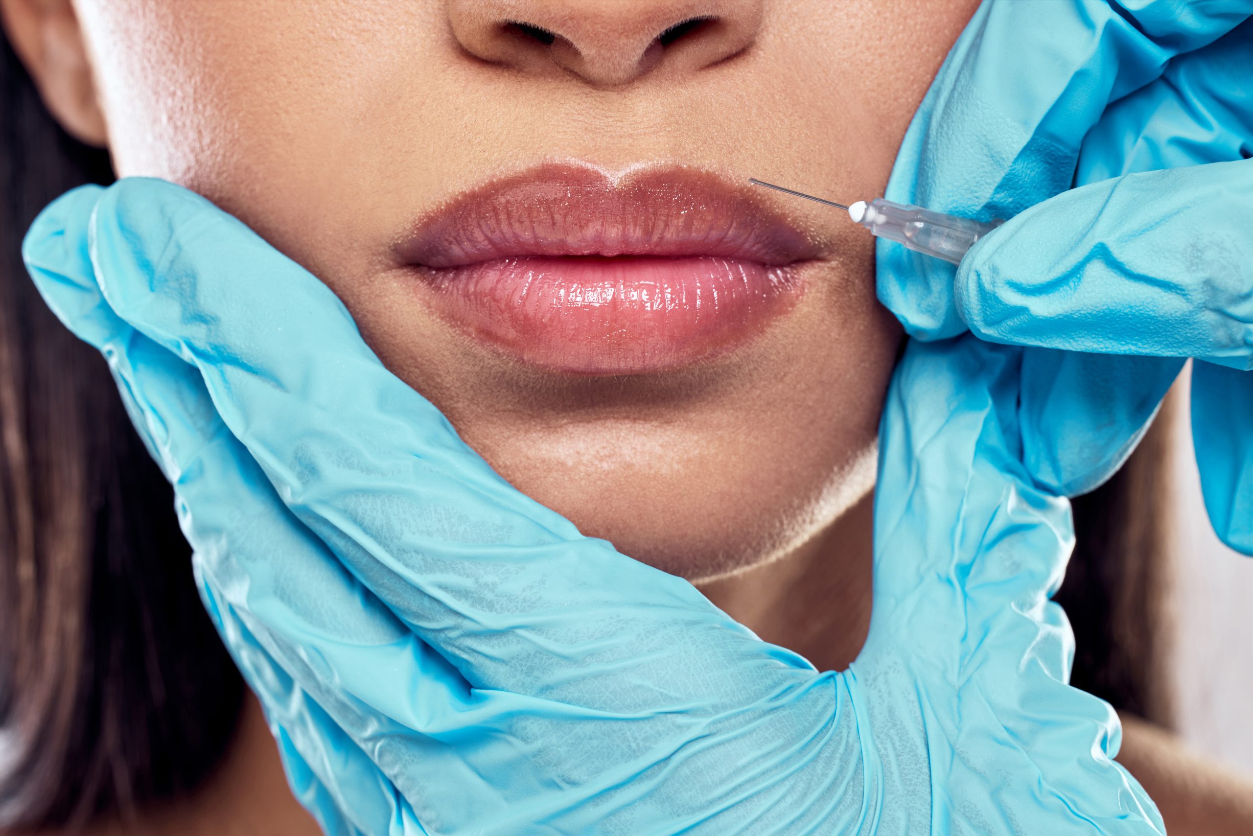 A photo of a woman receiving a lip flip at Dr. Laurel Bailey Laser and Aesthetics in Mechanicsburg, PA