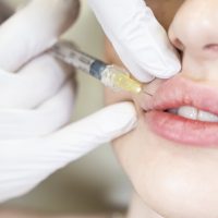A young woman gets lip filler injections of botox in her lips.